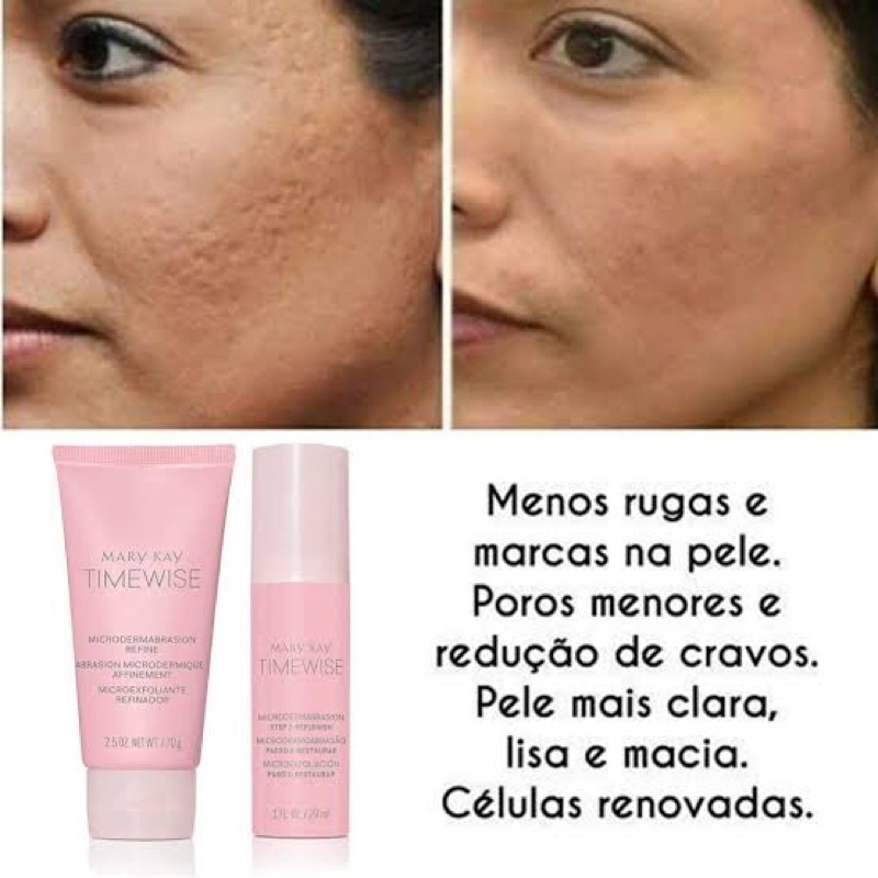 Kit Microdermoabras O Peeling De Cristal Shopee Brasil