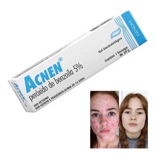 Tratamento Para Acne Hormonal Graus De Acne Oq É Bom Para Espinha ...