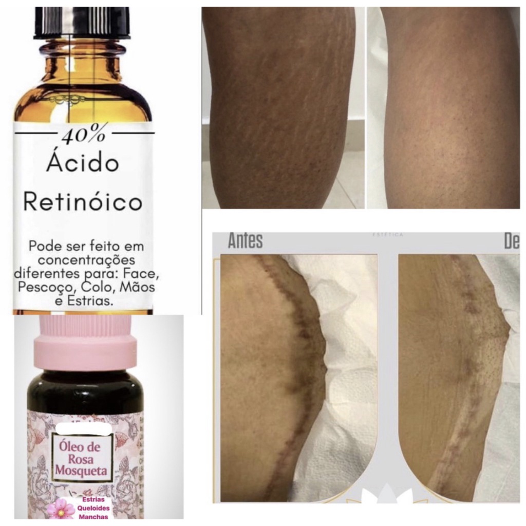 Pelling Para Estrias (ácido Retinoico 20ml) Promoção