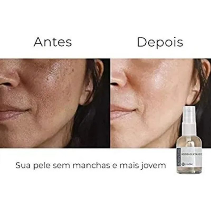 Ácido Glicólico para manchas e melasma | Shopee Brasil
