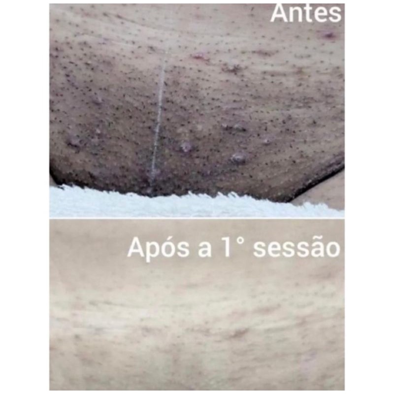 clareamento íntimo(clareador corporal e facial)ácido retinoico 40% ...