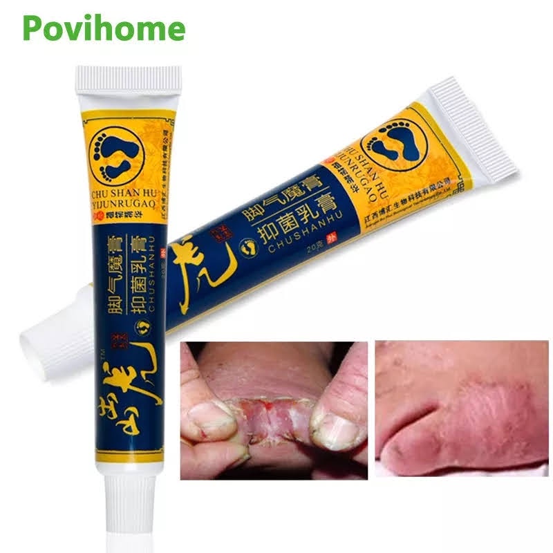 02 Pomada tratamento de Frieira Para Os Pés | Shopee Brasil