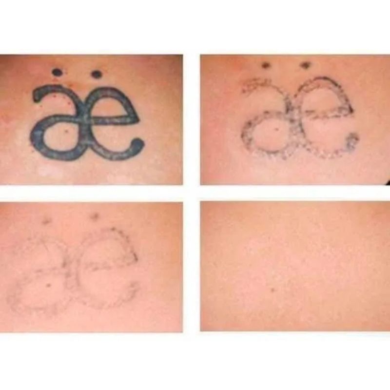 Remoção e clareador de tatuagem e micropigmentação 10 ml