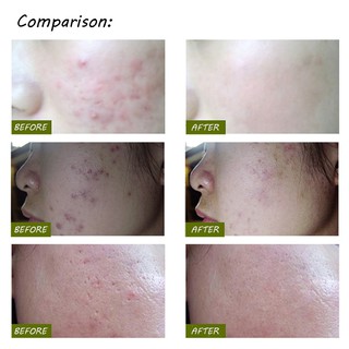 A Verdadeira Caneta Laser Samlox Remove Manchas Rugas | Shopee Brasil