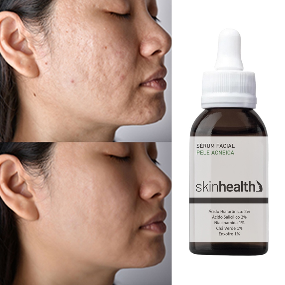 Pele Acneica Tratamento: Onde Comprar | BuscaProdutos