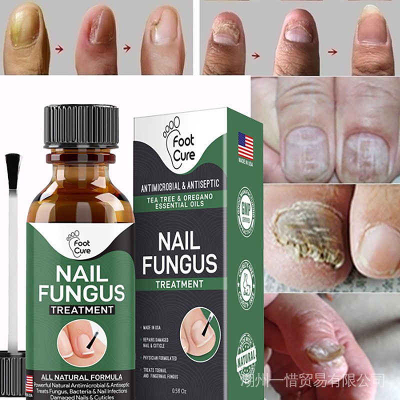 Tratamento De Fungos Nas Unhas extra Fortes , Melhor Reparo De , Parar O Crescimento , manicure