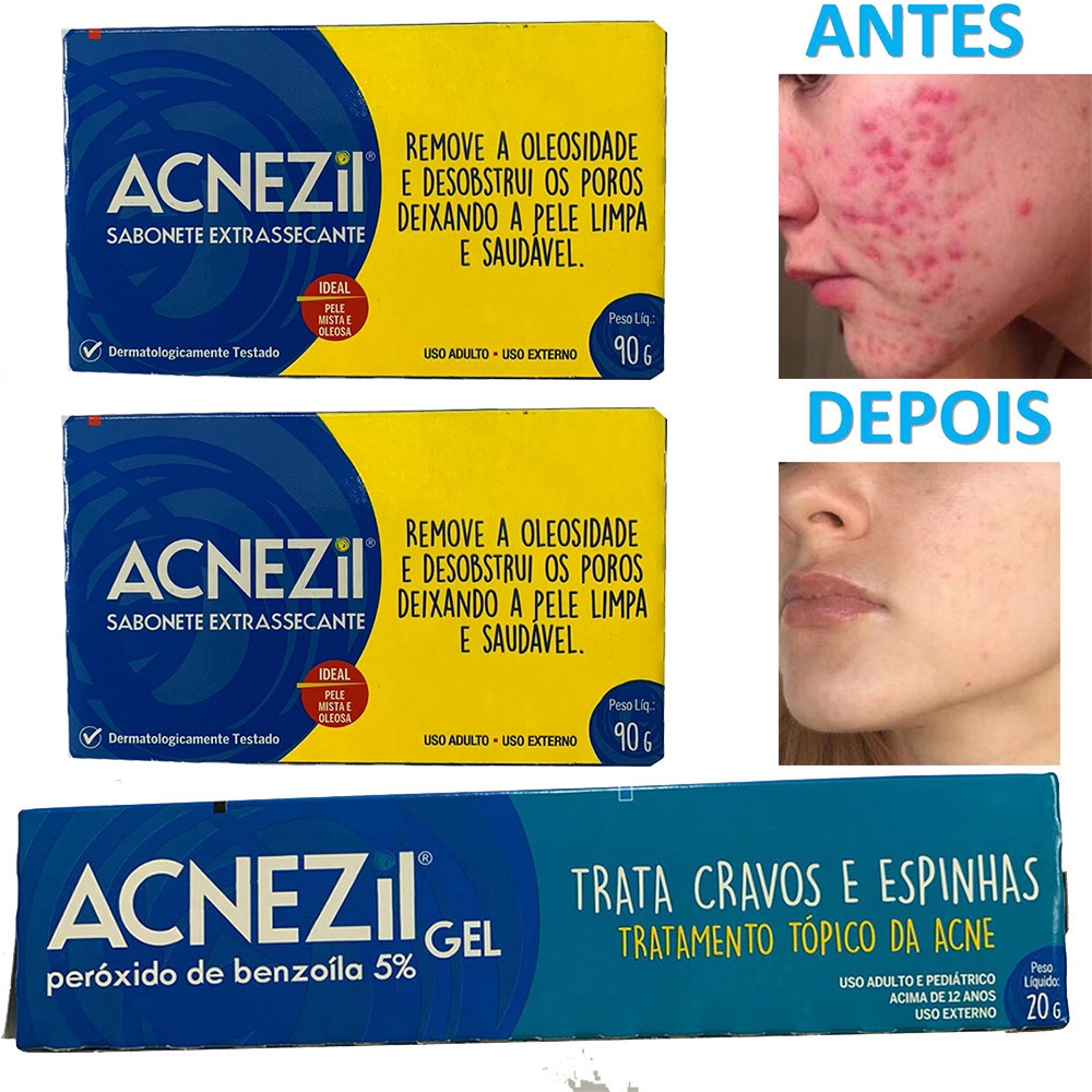 Kit Completo Para Tratamento De Acne Elimina Cravos E Espinhas Pomada Acnezil Sabonetes