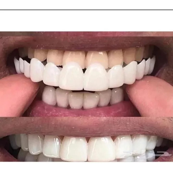 Modelo Novíssimo Do Snap Smile Parte De Cima e De baixo ( Par) *pronta Entrega