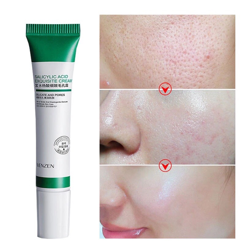 Creme De Ácido Salicílico Para Remoção De Poros Abertos E Acnes ...