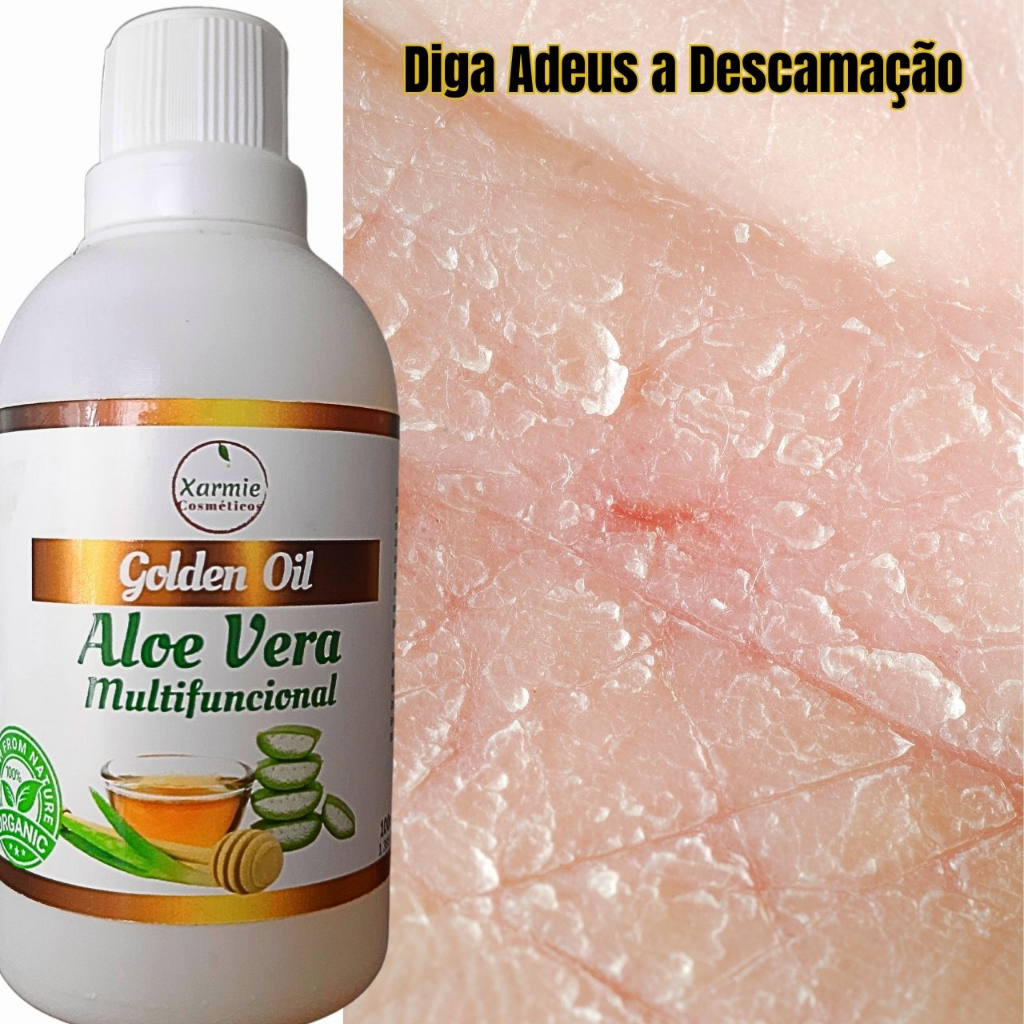 Óleo de Aloe Vera Babosa para Tratamento da Psoríase - Redução da ...
