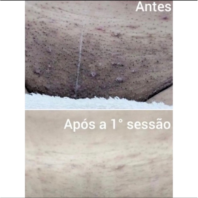 clareamento íntimo (ácid retinóic) clareamento axilas e virilhas
