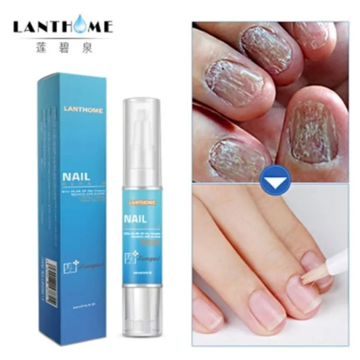 Lanthome Caneta c/ Solução para Unha Tratamento de Micose Anti Micose ...