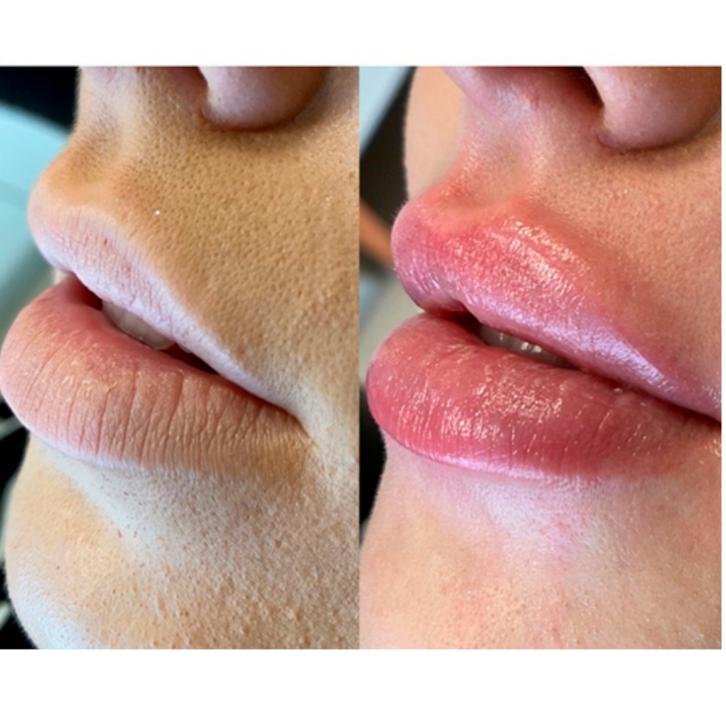 Derol Lip Maximizer Lip, batom Gloss para aumento labial, Efeito bocão,  lábios carnudos | Shopee Brasil