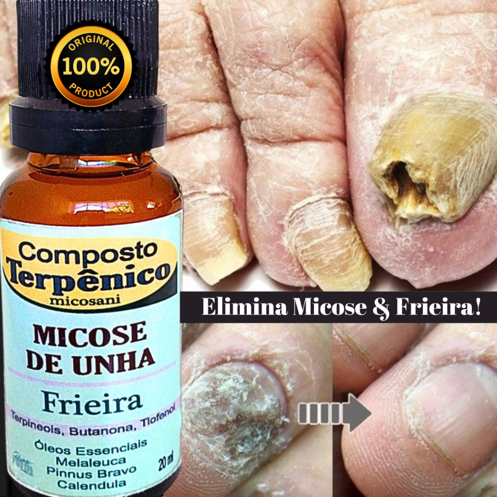 composto para micose de unha pode remover Ovicose e frieiras Nos dedos ...