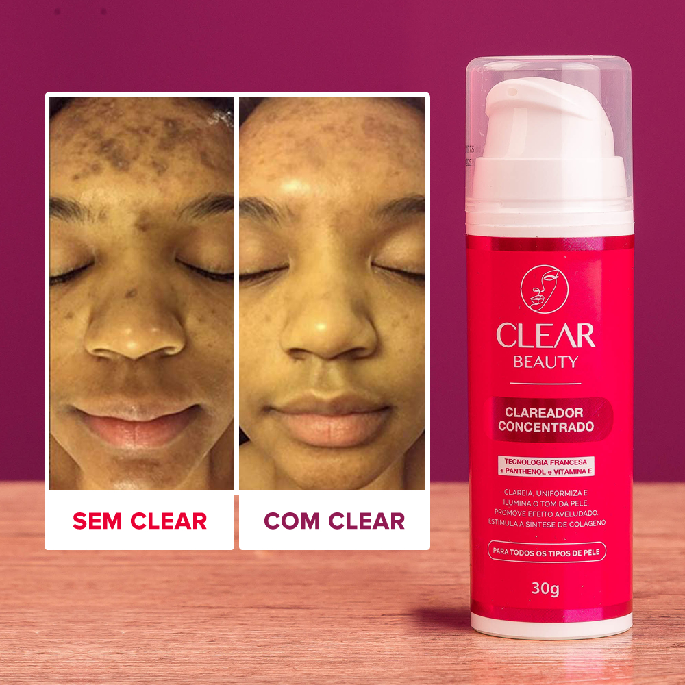 Clear Beauty - Clareador de manchas de Pele, Melasma e Acne - Envio ...