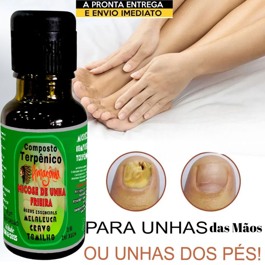 Tratamento remédio de unhas com fungos melaeuca - cravo- e tomilho ...