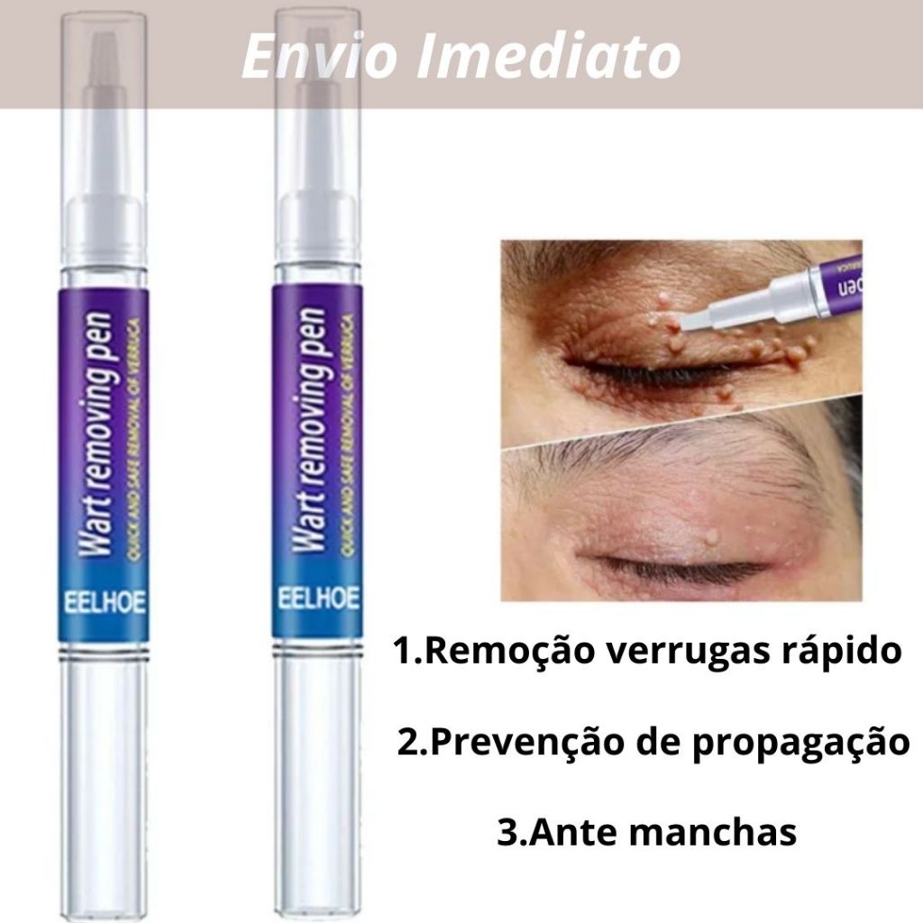 Removedor De Verrugas Caneta Original Sem Dor Remo O De Verrugas Envio Imediato Shopee Brasil