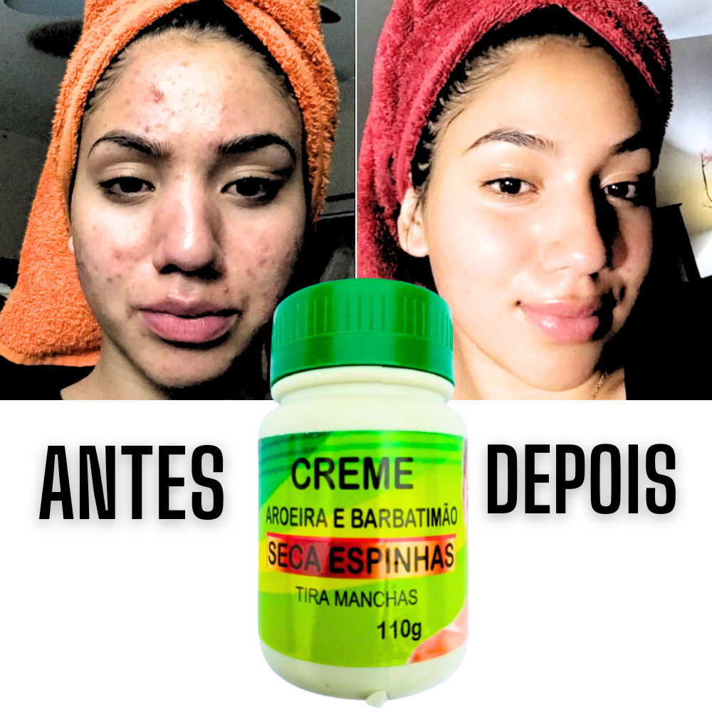 Creme Facial Seca Espinhas e Tira manchas do Rosto Melasma Aroeira e ...