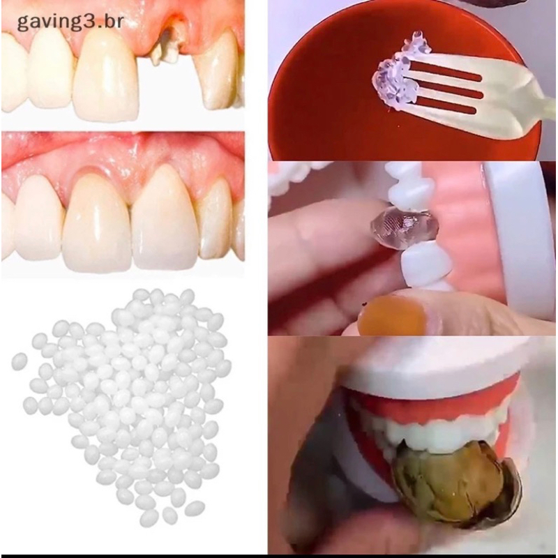 kit de reparo dental/dente +-250 bolinhas termoplástica