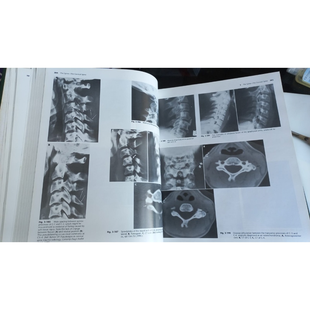 Atlas of Normal Roentgen Variants That May Simulate Disease - Theodore ...