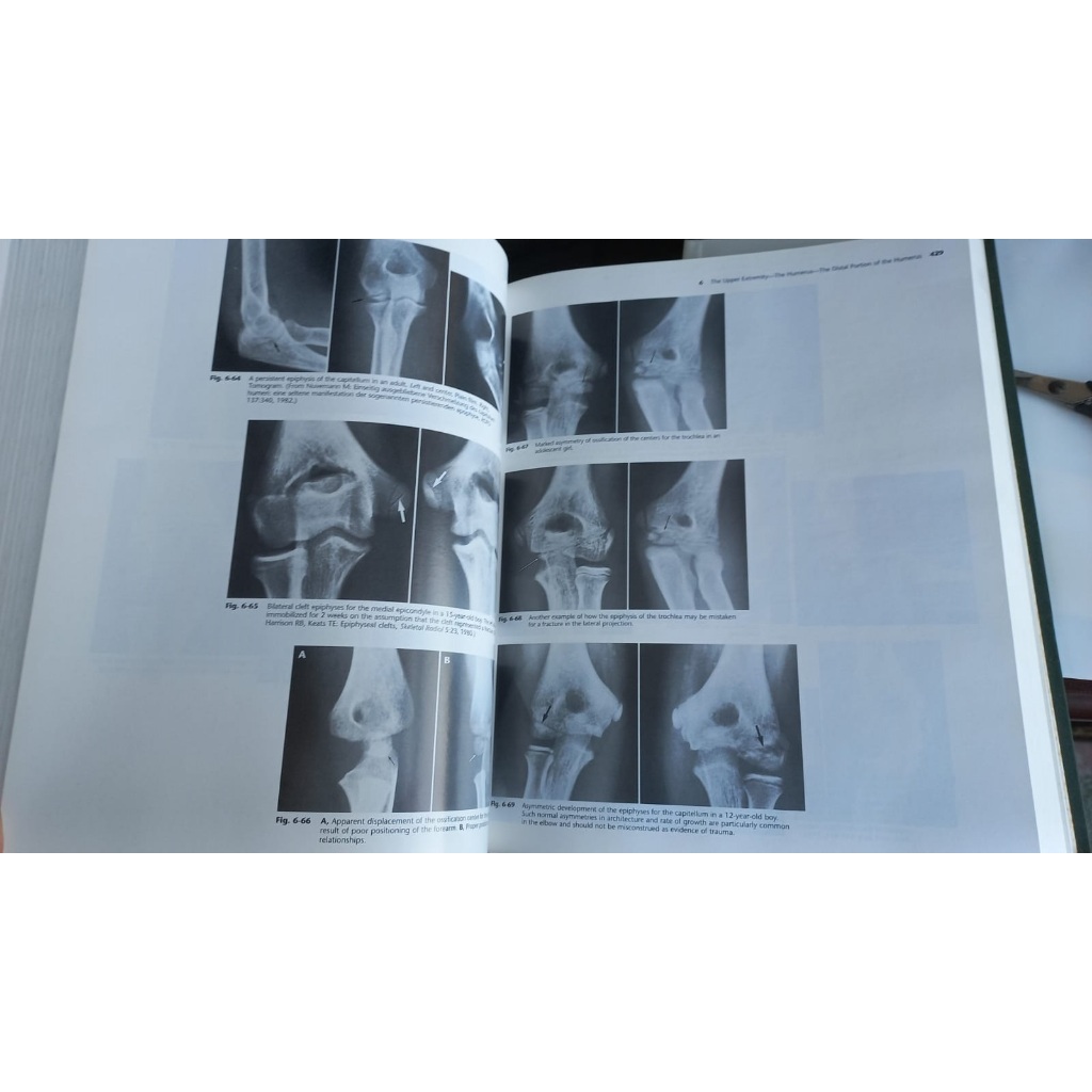 Atlas of Normal Roentgen Variants That May Simulate Disease - Theodore ...
