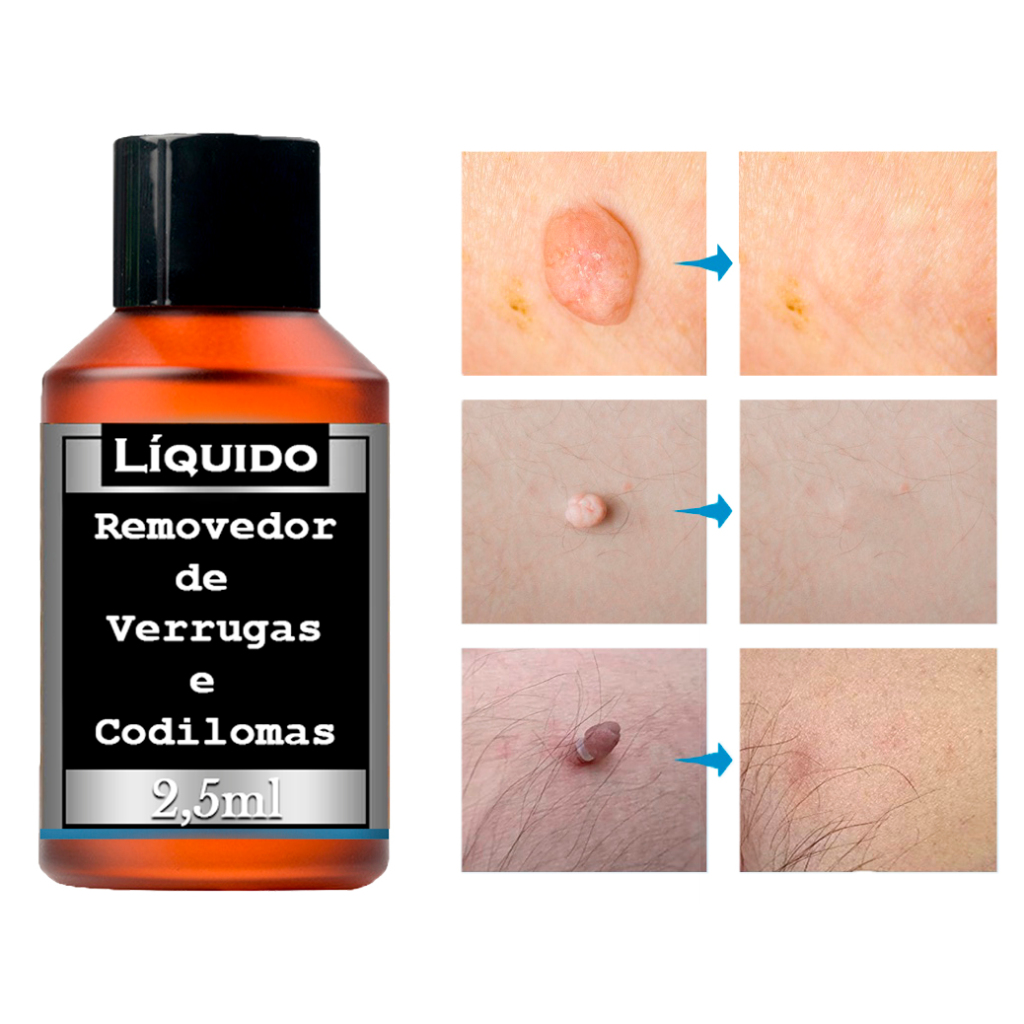 Remoção de Birrugas e Codilomas HPV - 100% Elimina Sem Retorno