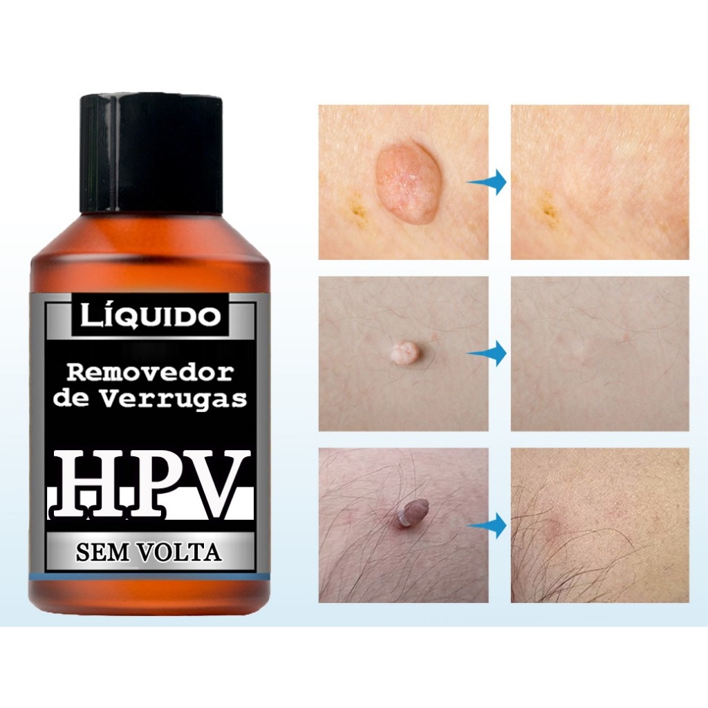 Removedor (5ml) I Envio Rápido no mesmo dia