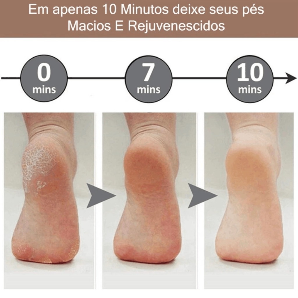 Imagem do produto Lixador de Pé Elétrico - Esfoliador Tira Calos Pedicure Portátil 4