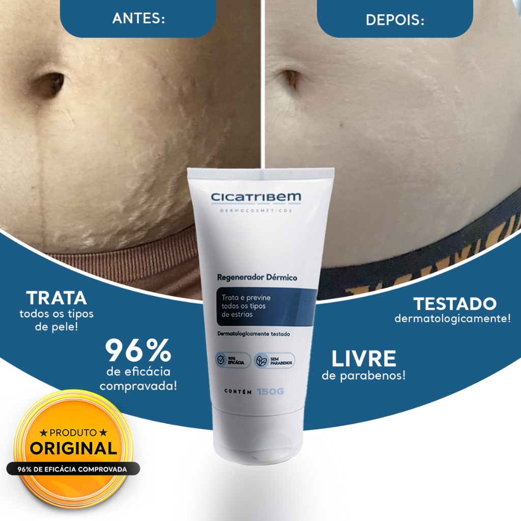 Creme para Estrias Cicatribem 150g - Trata Todos os Tipos de Estrias ...