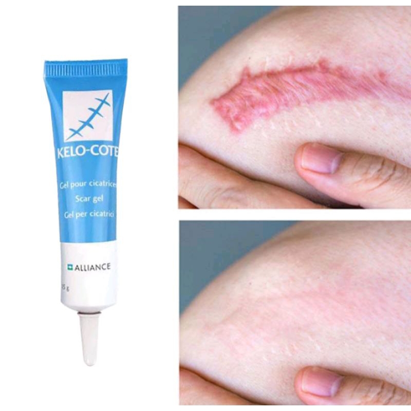 pomada kelo-cote gel 15g redutor de cícatrizes e queloides | Shopee Brasil