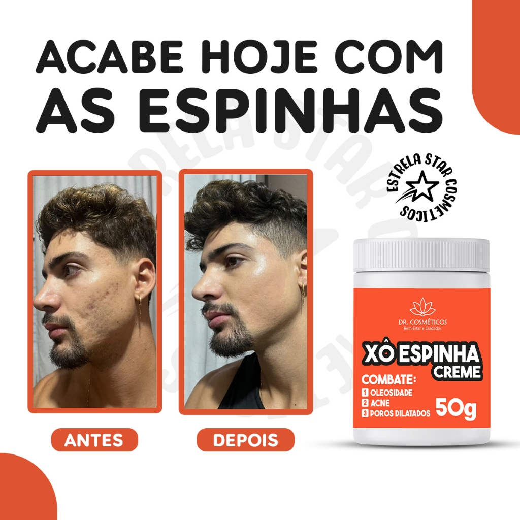 Pomada Xô Espinha NatyFlora 50g Anti Acne e Previne Espinhas e Cravos ...