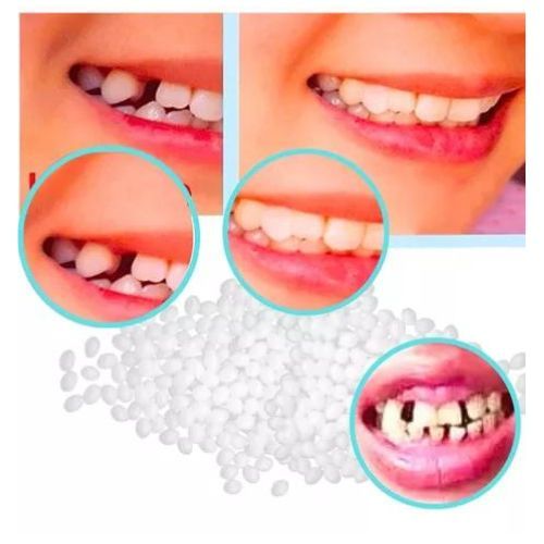 Conjunto Reparo Temporário bolinhas Resina Moldável Massa Fixadora Restauração