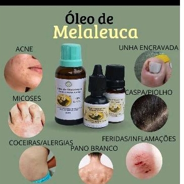 óleo vegetal de Melaleuca 10ml/ acnes/espinhas/micose/COCEIRAS | Shopee ...