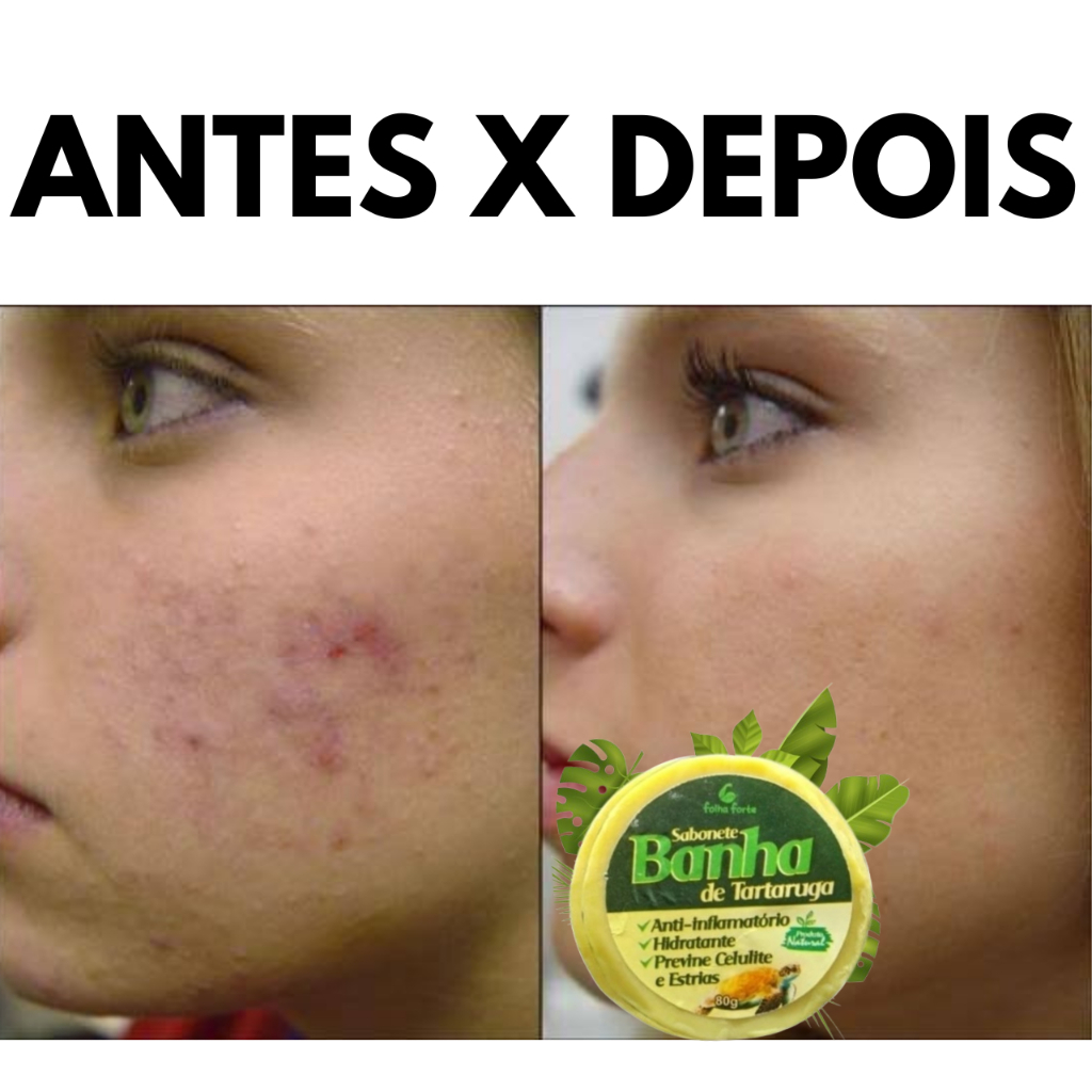 KIT SABONETE NATURAL ANTIACNE BANHA DE TARTARUGA, TIRA ESPINHAS ...