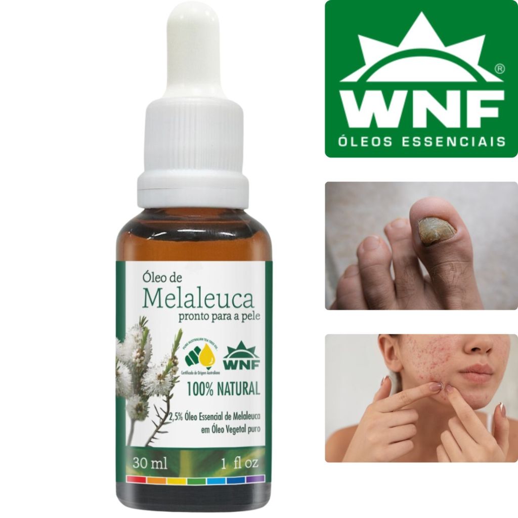 Oleo de Melaleuca para Acne Pele Oleosa Unha Caspa WNF 30ml | Shopee Brasil