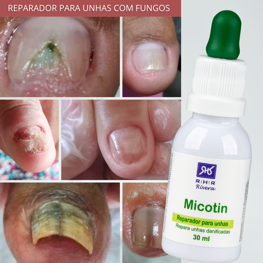 Remédio Para Micose de Unhas - Micotin 30ml Conta Gotas | Shopee Brasil