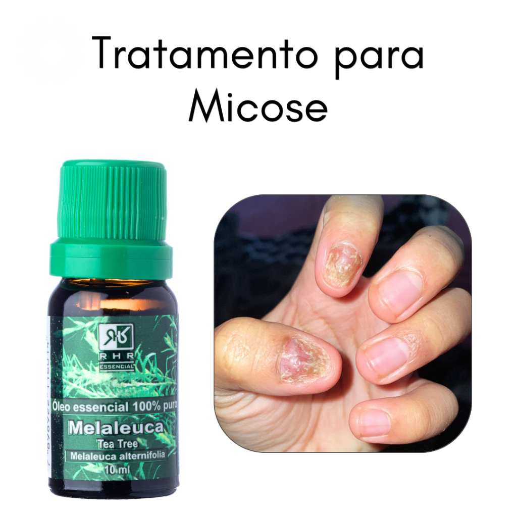Remédio para Micose de Unha - Óleo Essencial de Melaleuca 10ml | Shopee ...