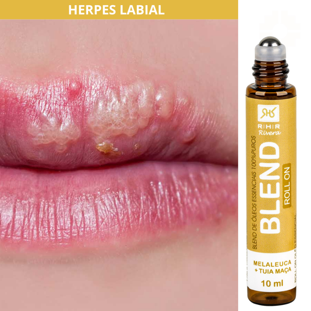 Remédio para Herpes Labial - Blend Roll-on 10ml | Shopee Brasil
