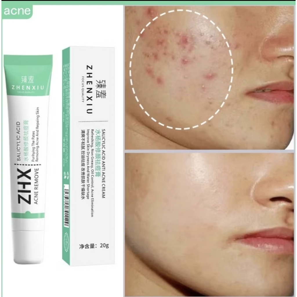 フェイスクリーム ohpin Creme Antiacne ZHX ZHENXIU com Ácido Salicílico e Extratos