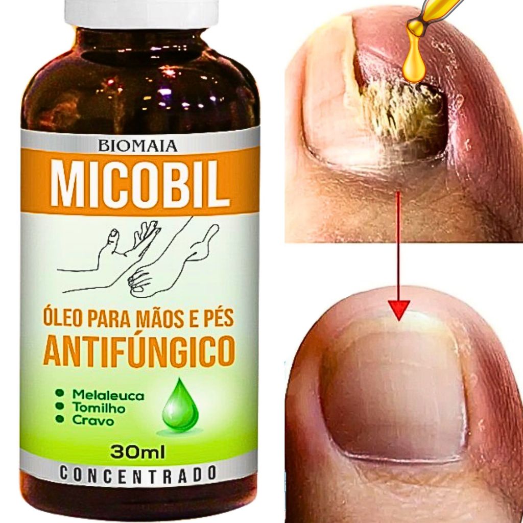 Micose de Unha Óleo Antimicótico 30ml - Reparador Para Unhas Com Fungos ...
