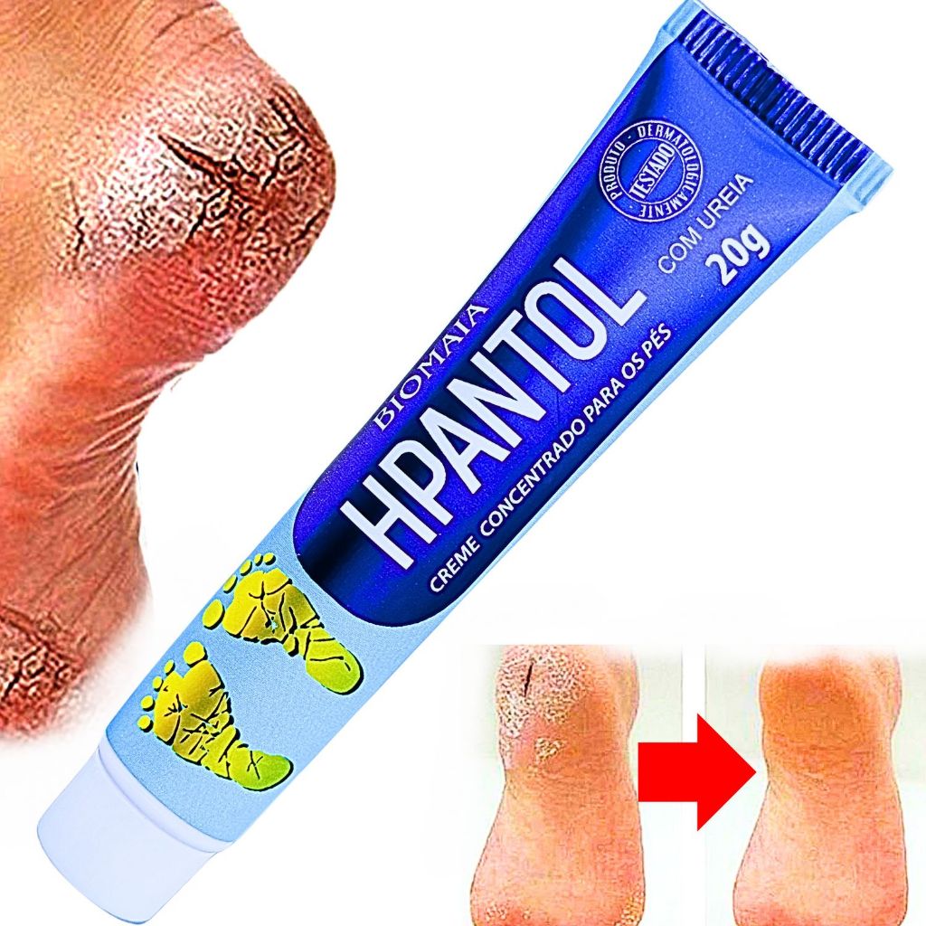 Creme Para os Pés, Mãos e Cotovelos Calcanhar Rachados Hidratante Para ...