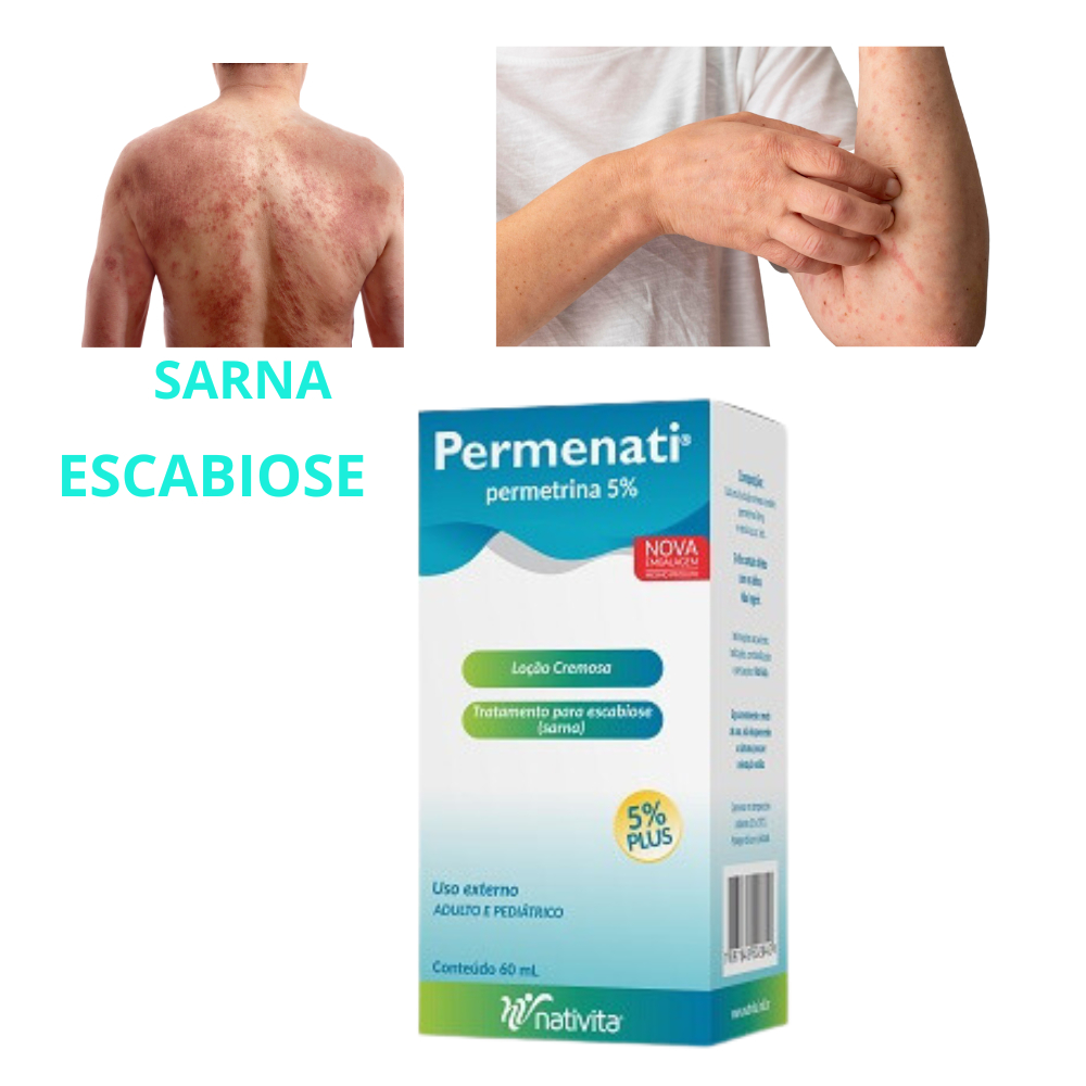 Permenati 5% Permetrina Loção para Sarna Escabiose Coceira no Corpo ...