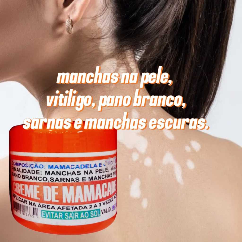 Creme Mama Cadela Tratamento Natural para Vitiligo, Pano Branco e ...