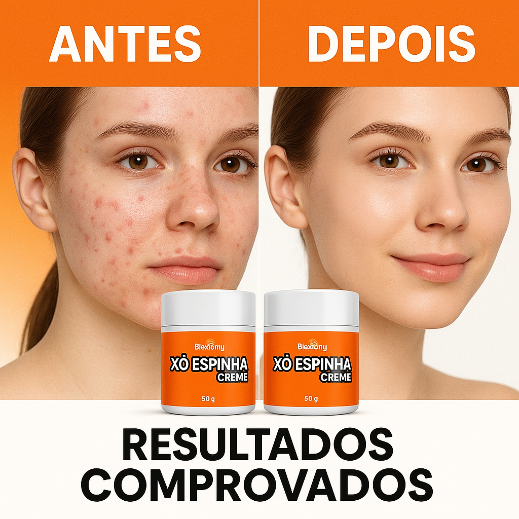 Kit 2 Creme Xô Espinha 50g – Antiacne, Controle da Oleosidade e Pele ...