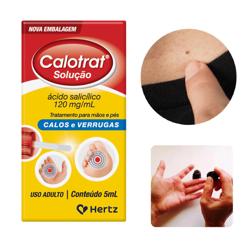 Calotrat 5ml Anti Verrugas Calos Calosidades | Shopee Brasil