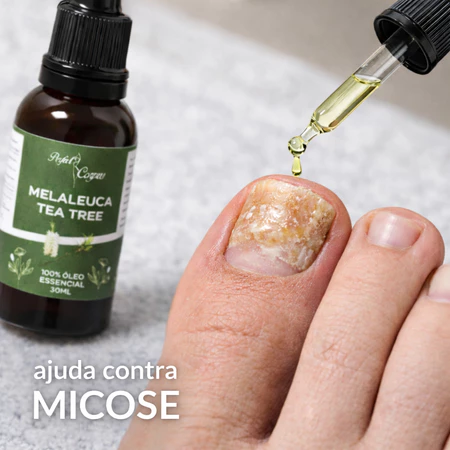 Óleo Essencial De Melaleuca 100% Puro 30ml Contra Micose Acne