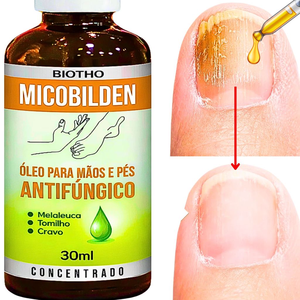 Micose de unhas Micoses de Pele Micoses de pé Micobilden tonifica e ...