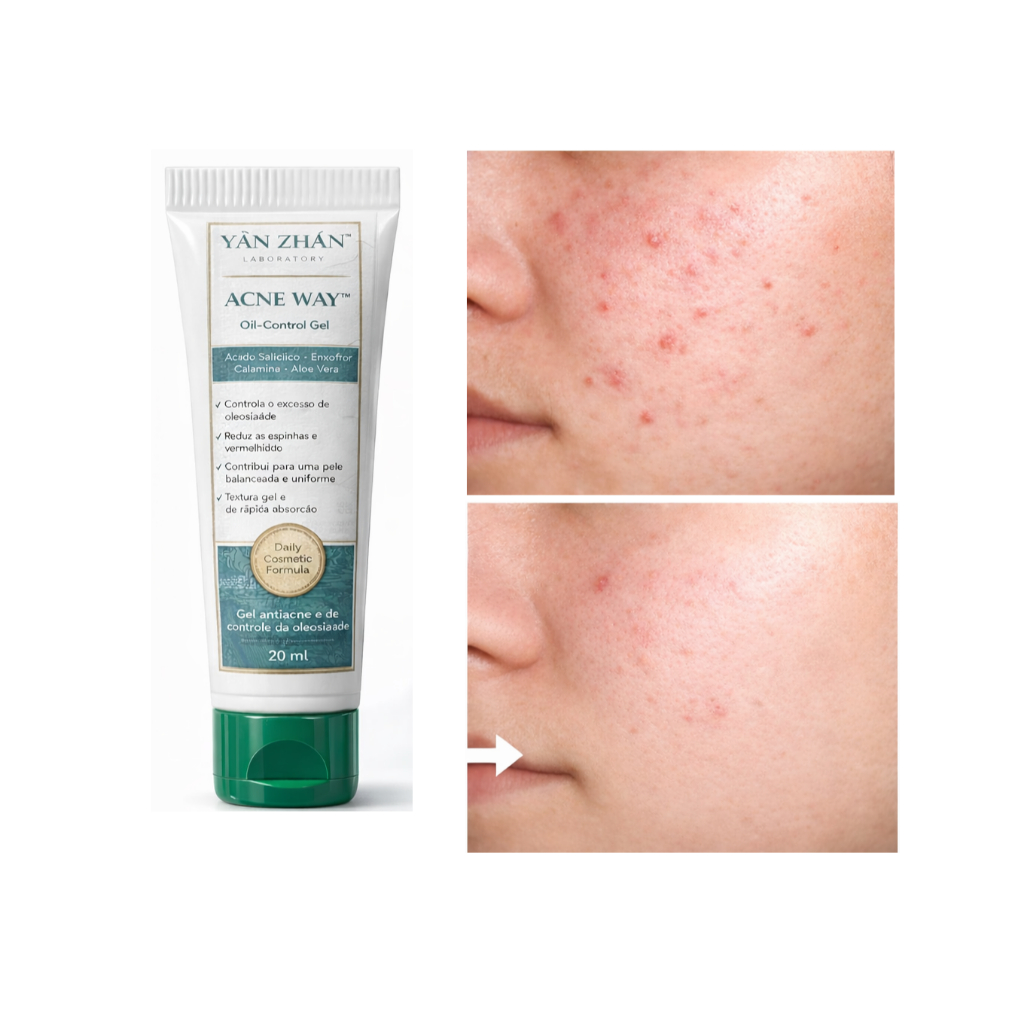 Melhor Creme Para Tirar Acne E Espinhas Mancha No Rosto | Shopee Brasil