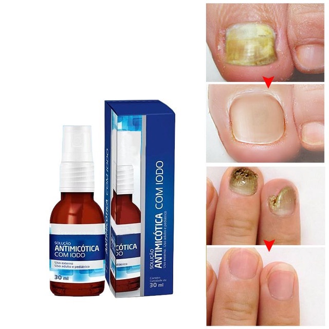 Remédio Micose De Unha Com Micose | Shopee Brasil