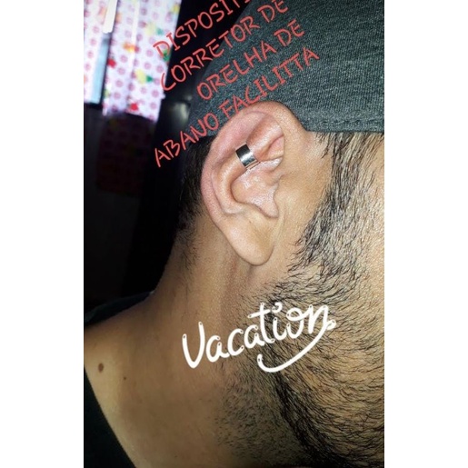 Dispositivo corretor de orelha de abano Otyplus